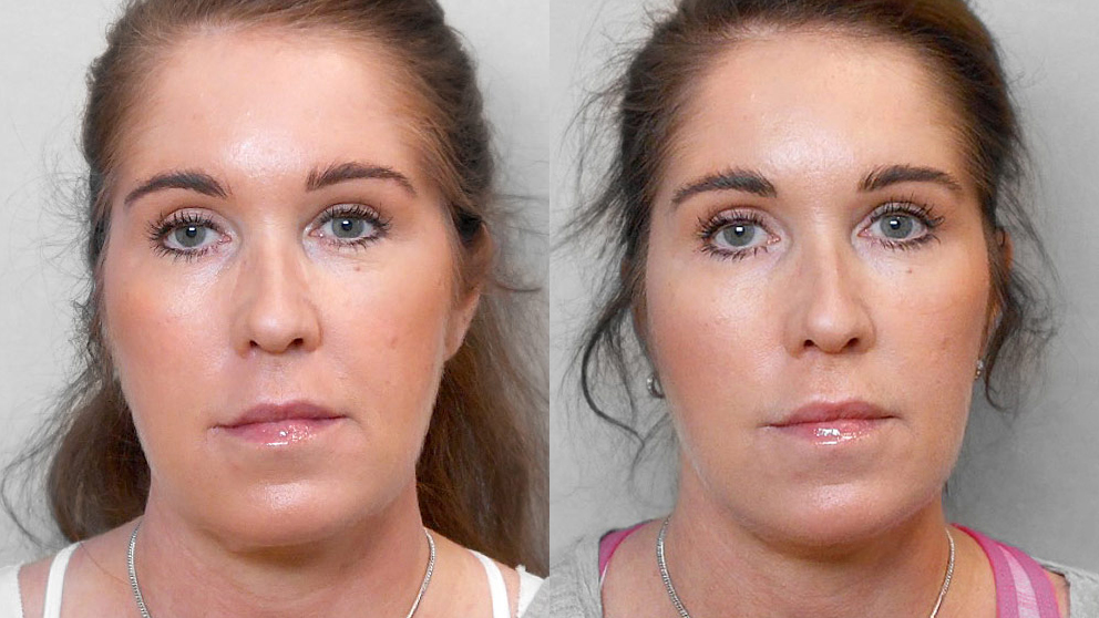 Före- och efterbild på kvinna som genomfört ett ansiktslyft + övre ögonlocksplastik.