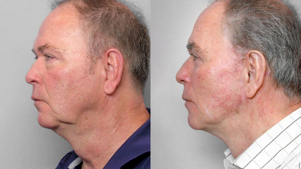 an in left profile, before and after facelift, upper + lower eyelid surgery + Total FX laser treatment.