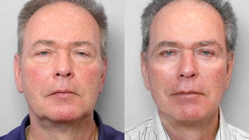 Bild på man före och efter ansiktslyft, övre + undre ögonlocksplastik + Total FX laserbehandling.