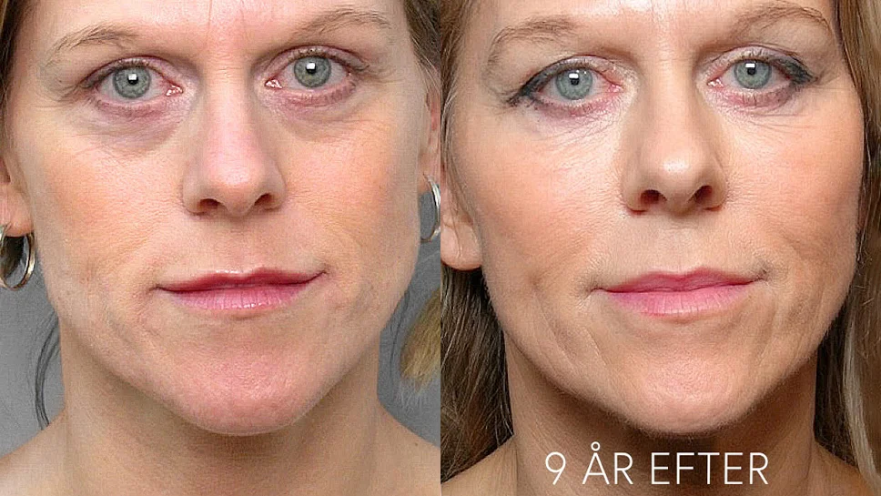 Picture of a woman before and 9 years after treatment with fat injection under the eyes.