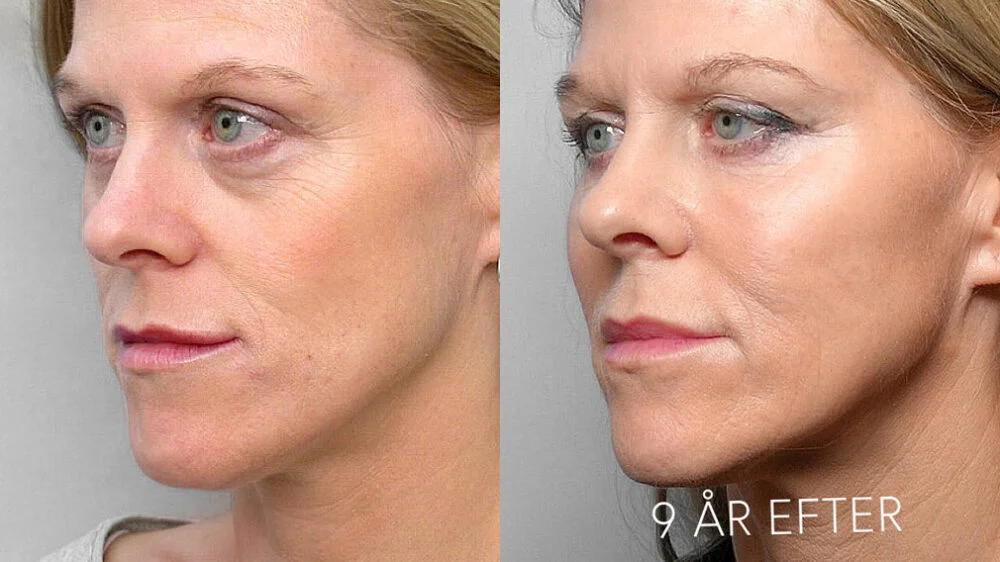 Picture of woman in half profile, before and 9 years after treatment with fat injection under the eyes.