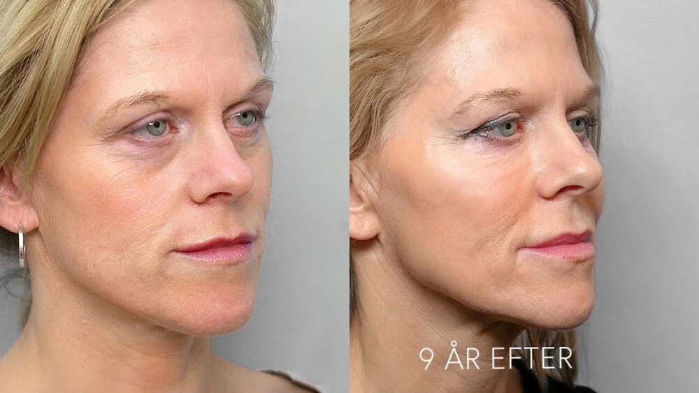 Image of woman in right half profile, before and 9 years after treatment with fat injection under the eyes.