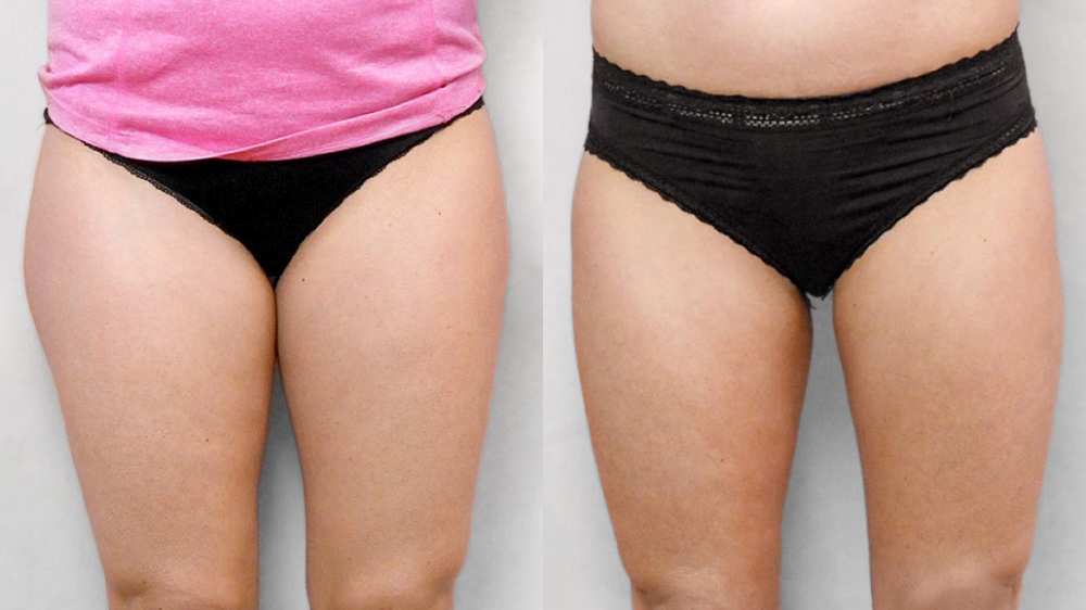 Bild av kvinnas framsida, före och efter genomförd fettsugning av lår.
