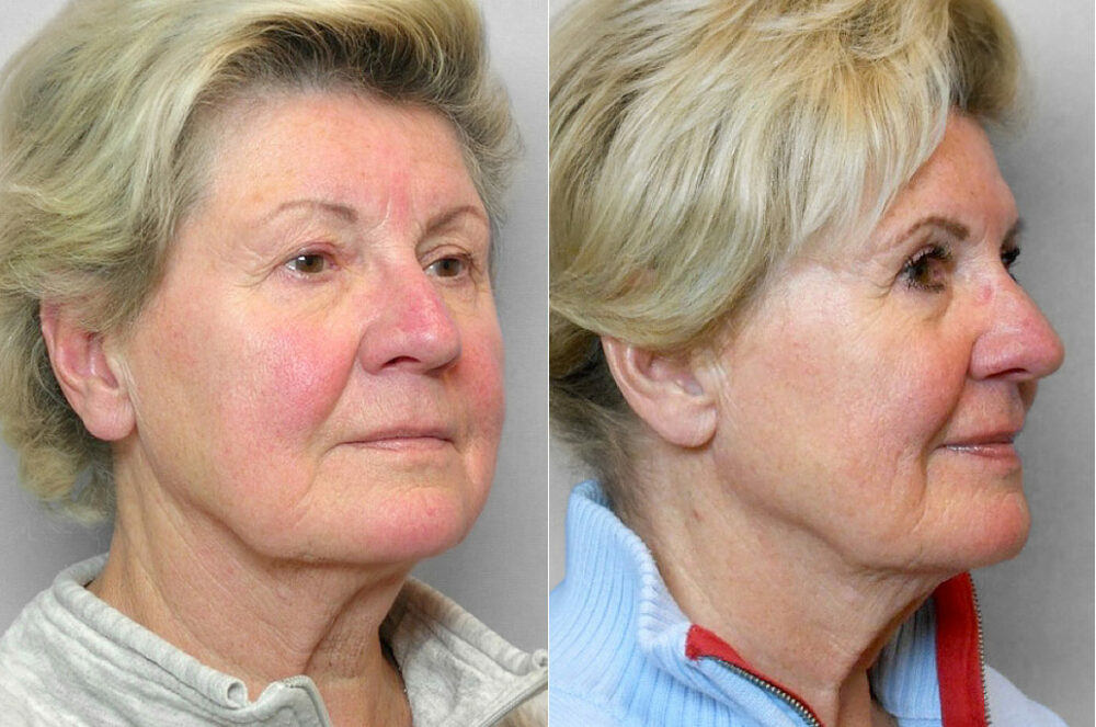 Före- och efterbild på kvinna i höger halvprofil, som genomfört ögonlocksplastik på övre ögonlock.