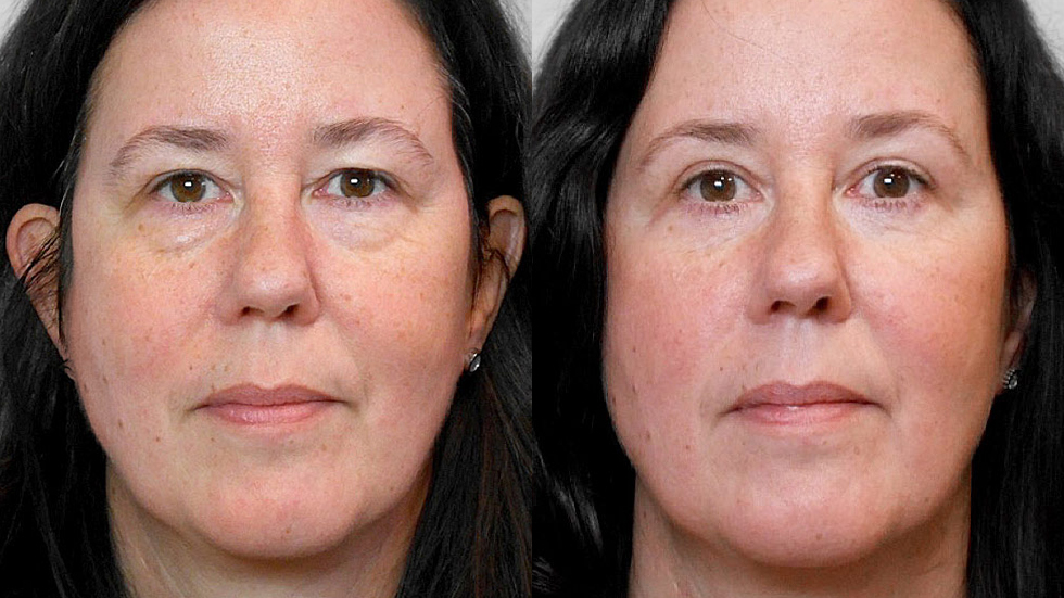 Bild av kvinna från före och efter en genomförd ögonlocksplastik, för övre och undre ögonlock.