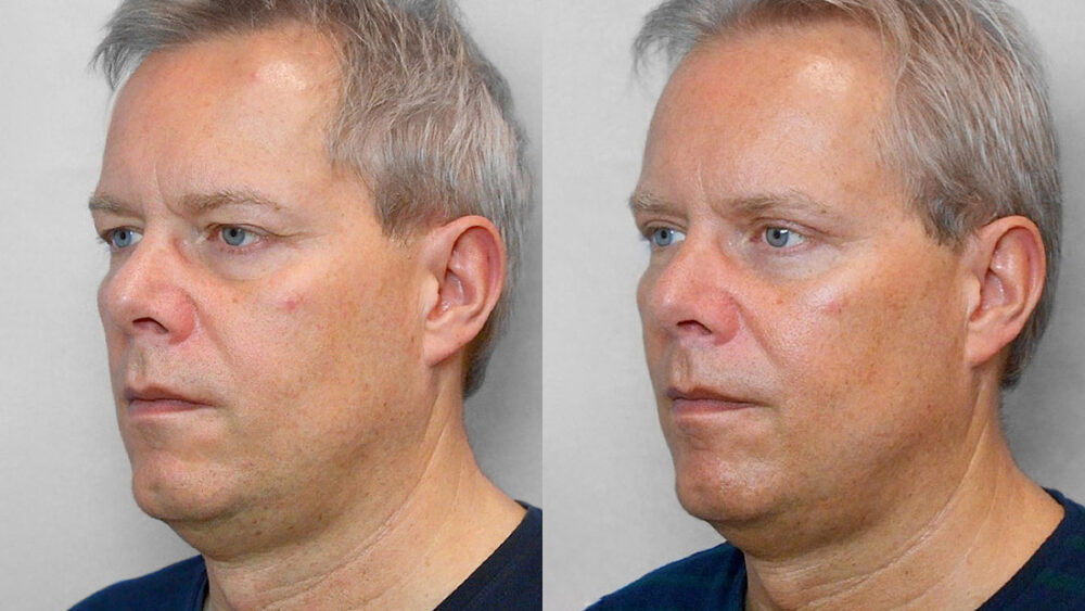 Image of a man in left half profile, who has undergone upper eyelid surgery - before and after treatment.