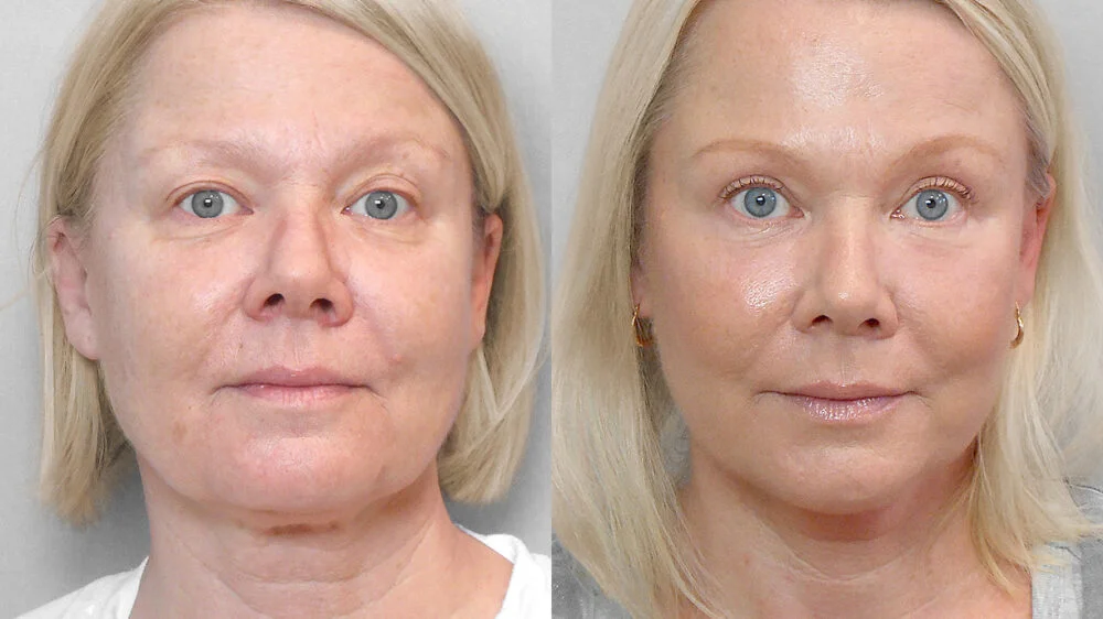 Before and after picture, woman who had a facelift, forehead lift, eyelid surgery, fat injection and a skin care programme.