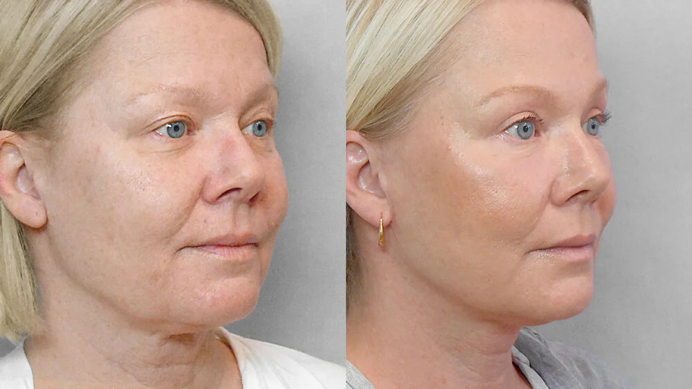 Half profile before and after picture of a woman who has had a facelift, brow lift, eyelid surgery, fat injection and a skin care programme.