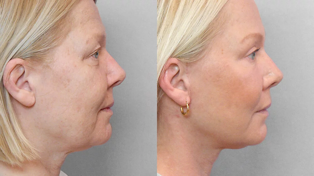 Before and after picture in profile of a woman who has had a face lift, brow lift, eyelid surgery, fat injection and a skin care programme.