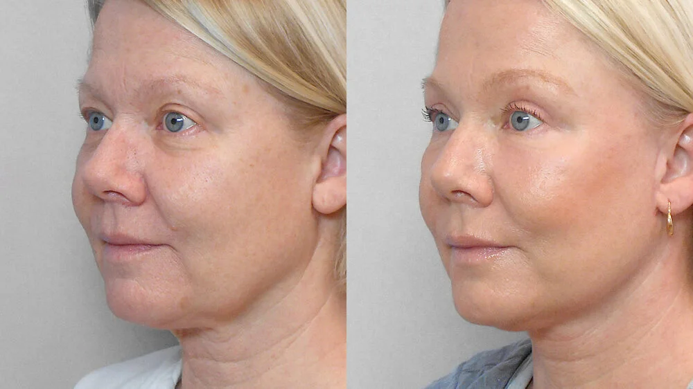 Half profile before and after picture of a woman who has had a facelift, brow lift, eyelid surgery, fat injection and a skin care programme.
