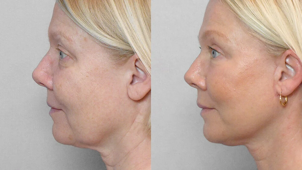 Before and after picture in profile of a woman who has had a face lift, brow lift, eyelid surgery, fat injection and a skin care programme.