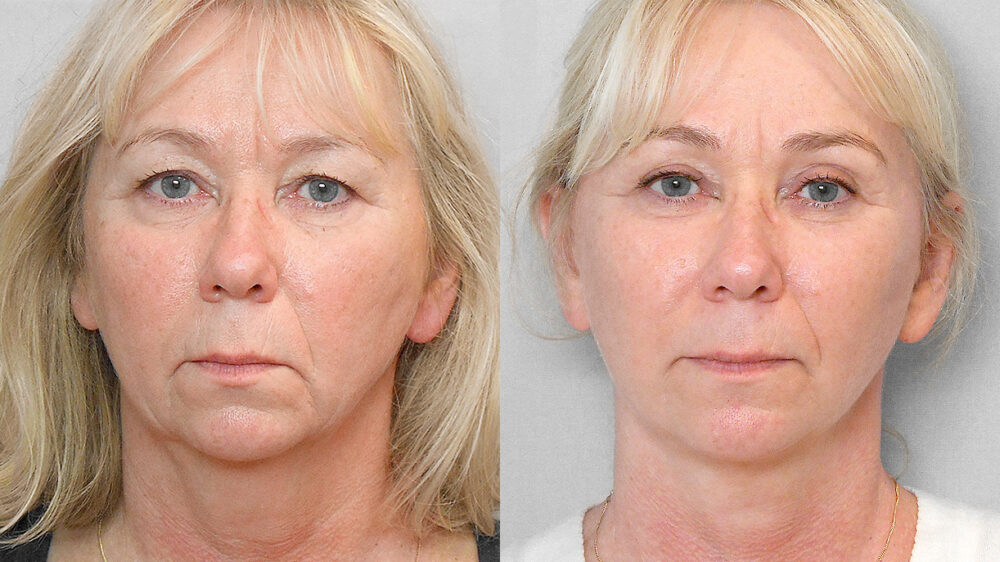 Before and after picture of a woman who had a facelift, forehead lift, eyelid surgery and a fat injection.