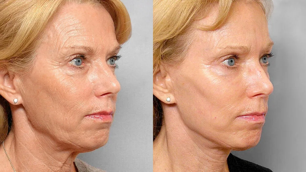 Before and after picture in half profile of a woman who has had a face lift, skin care treatment, chemical peeling.