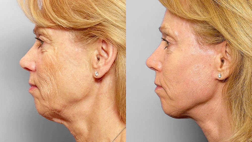 Före och efter-bild i profil på kvinna som genomgått ansiktslyft, hudvårdsbehandling, kemisk peeling.