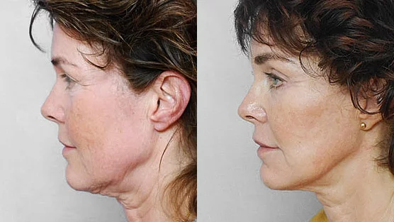 Before and after picture of a woman in profile, who had a facelift, endoscopic forehead lift + fat injection in the face.