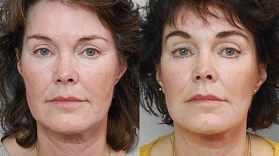 Before and after picture of a woman having a facelift + endoscopic forehead lift + facial fat injection.