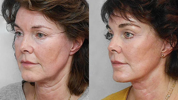 Before and after picture of a woman in half profile, who had a facelift, endoscopic forehead lift + fat injection in the face.