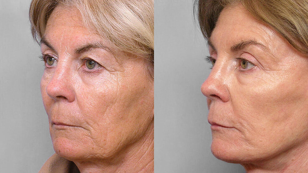 Before and after picture of a woman in semi-profile undergoing a facelift, eyelid surgery, and skin care treatment.