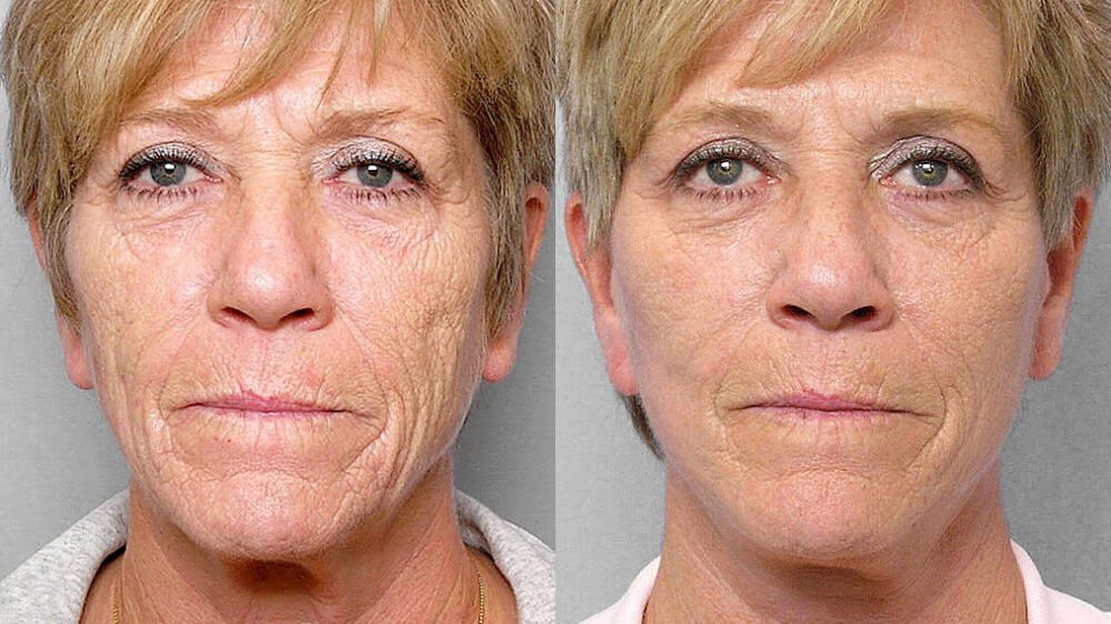 Före och efter-bild på kvinna som genomgått ett ansiktslyft, total FX-laser samt kemisk peeling på hals.