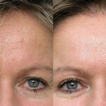 Detaljbild på kvinna före och efter behandling med botox i pannan