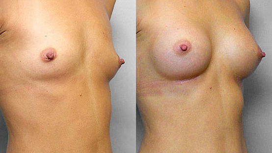 Bild på kvinna i höger halvprofil, före + efter bröstförstoring, med bröstimplantat Mentor Runda High Profile 200 cc.