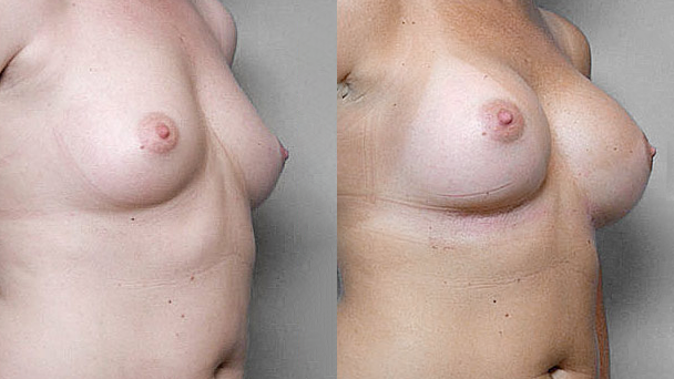 Före- och efterbild i höger halvprofil, på resultatet efter bröstförstoring med Bröstimplantat Mentor, anatomiska.