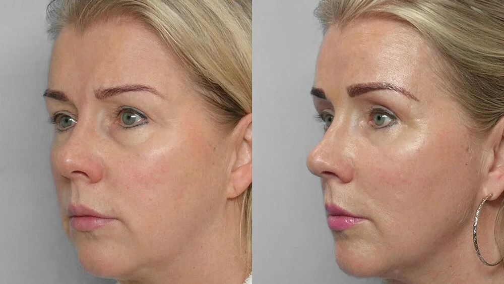 Picture of woman in profile, before and after endoscopic brow lift, upper eyelid surgery + fat injection under eyes.