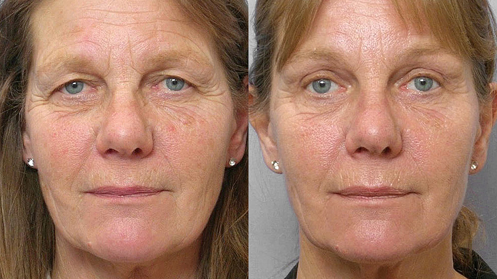 Bild på kvinna före och efter genomförd undre + övre ögonlocksplastik, samt endoskopiskt pannlyft.