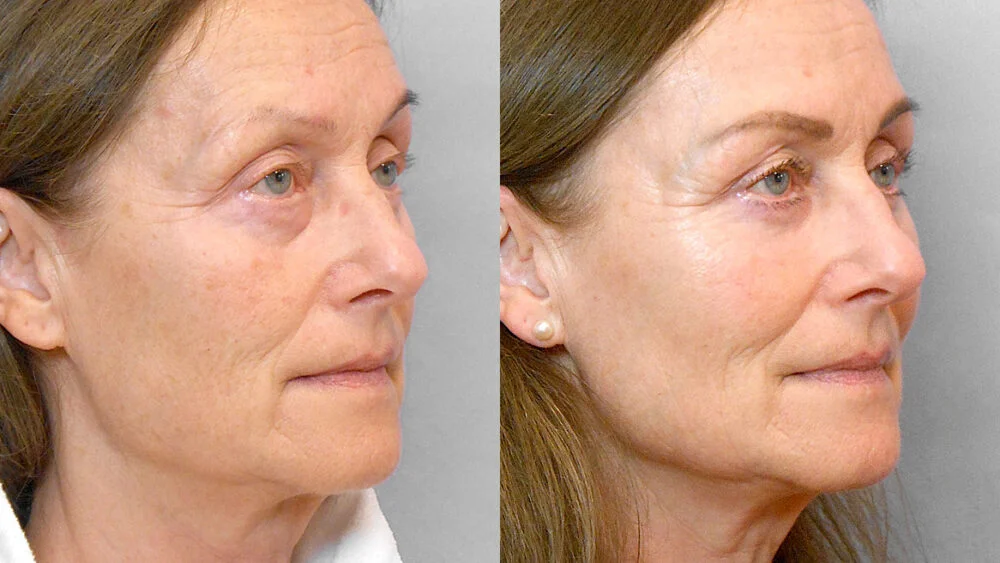Half-profile before and after picture of a woman who has had a fat injection under her eyes and in her temples.
