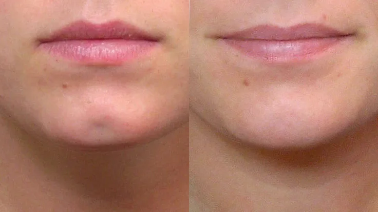 Zoomed-in before and after picture of a person who has had a fat injection into a dimple in the chin.