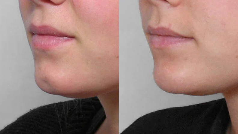 A zoomed-in before and after picture of a person in a left half-profile who has carried out a fat injection into a pit in the chin.