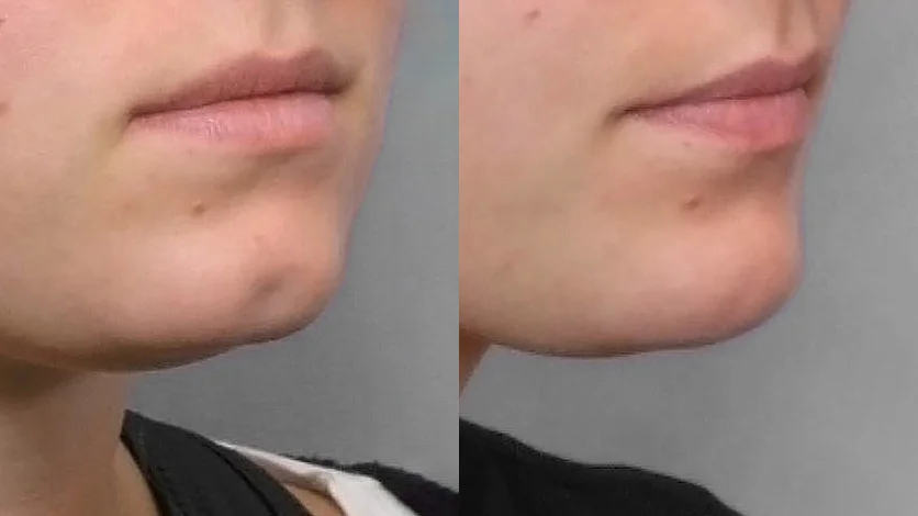 A zoomed-in before and after picture of a person in a right half-profile who has carried out a fat injection into a pit in the chin.