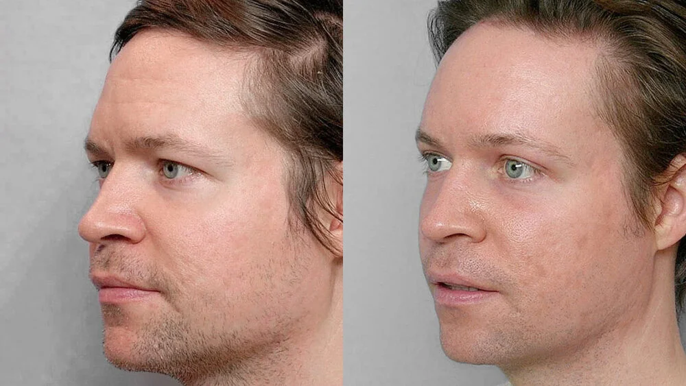 Before and after picture of a man in profile who had a forehead lift + fat injection under the eyes + eyelid surgery + laser treatment.