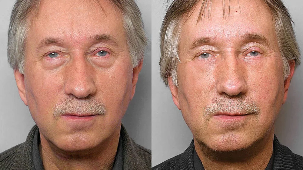 Before and after picture of a man who received treatment with fat injection under the eyes + laser treatment TotalFX laser.