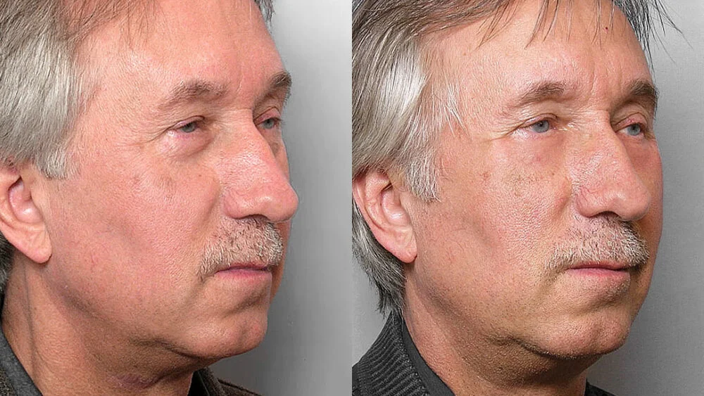 Before and after picture of a man in the right half profile, who received fat injection under the eyes + laser treatment TotalFX laser.