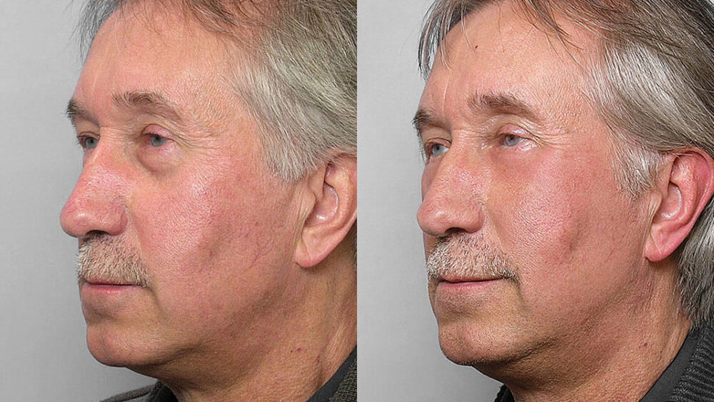 Before and after picture of a man in the left half profile, who received fat injection under the eyes + laser treatment TotalFX laser.