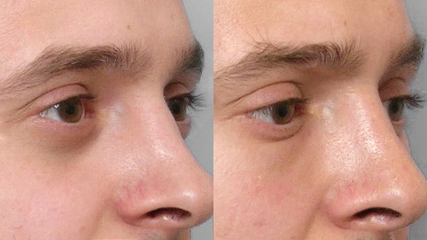 Zoomed-in before and after picture of a person in semi-profile having a fat injection under the eyes.