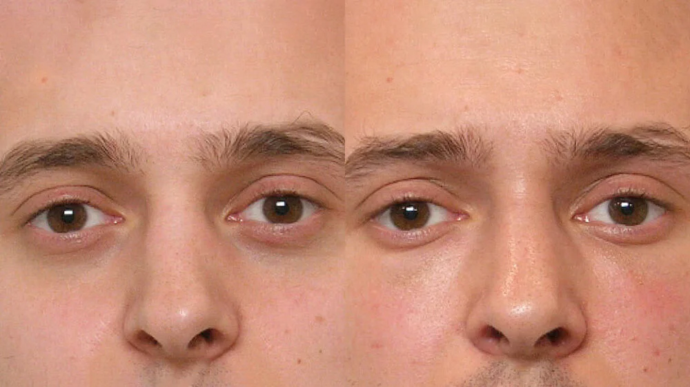 Zoomed-in before and after picture of a person who has had a fat injection under the eyes.