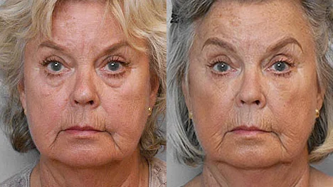 Before and after picture of a woman who has undergone fat injection treatment under the eyes.