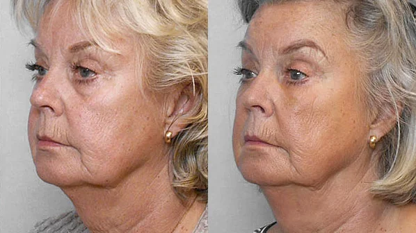 Before and after picture of a woman in left half profile, having undergone treatment with fat injection under the eyes.
