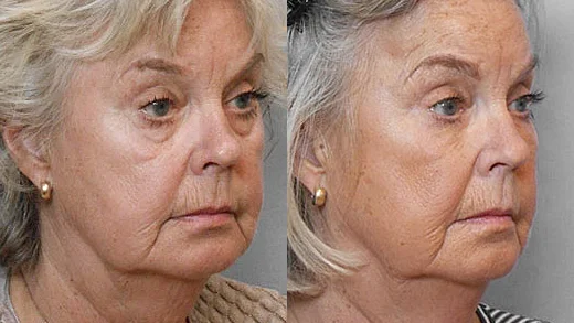 Before and after picture of a woman in right half profile, having undergone treatment with fat injection under the eyes.