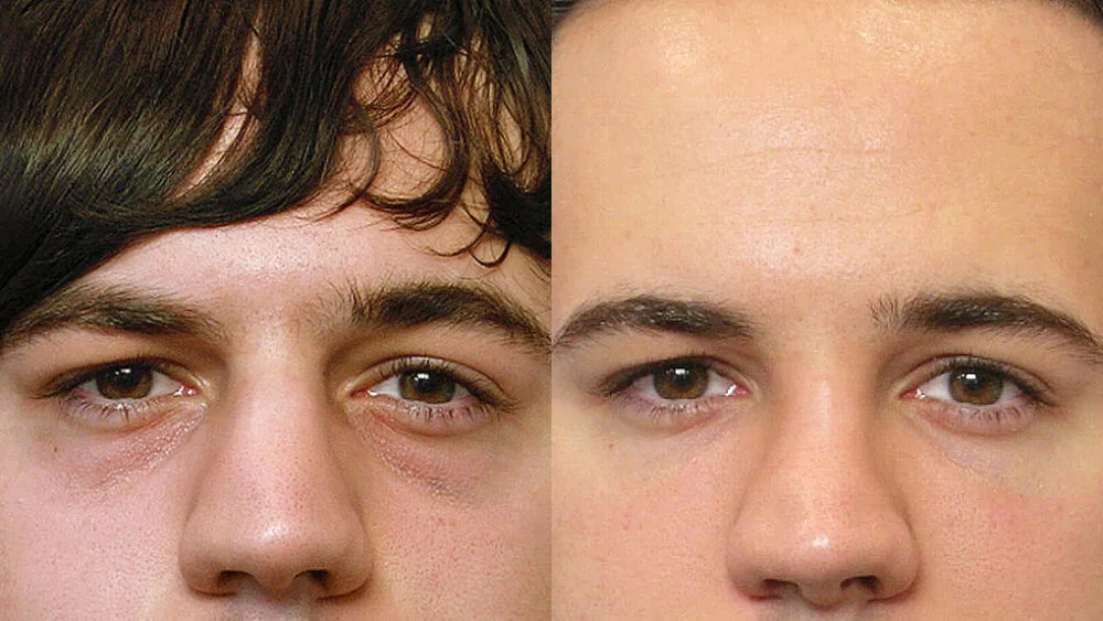 Detail of person before and after treatment with fat injection under the eyes.
