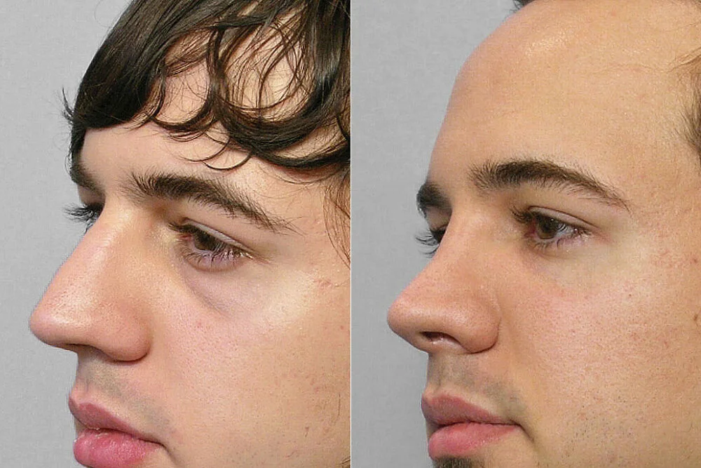 Detail of person in half profile, before and after treatment with fat injection under the eyes.