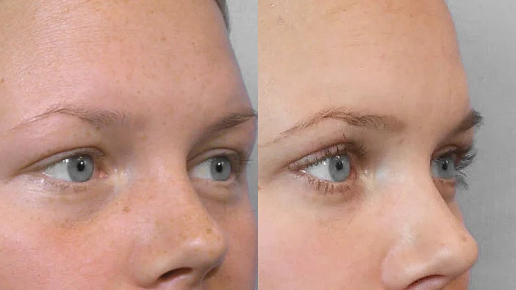 Detailed before and after picture of a person in right half profile who has had a fat injection under the eyes.