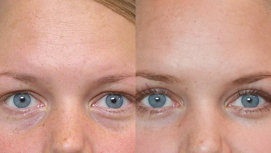 Detailed before and after picture of a person having a fat injection under the eyes.
