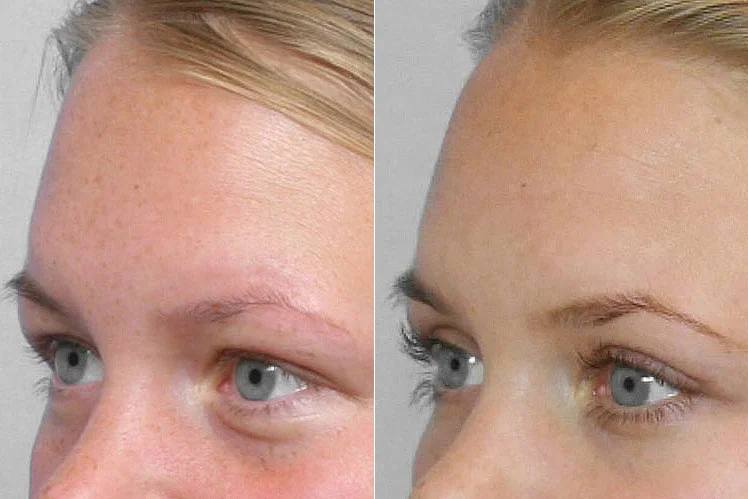 Detailed before and after picture of a person in left half profile having a fat injection under the eyes.