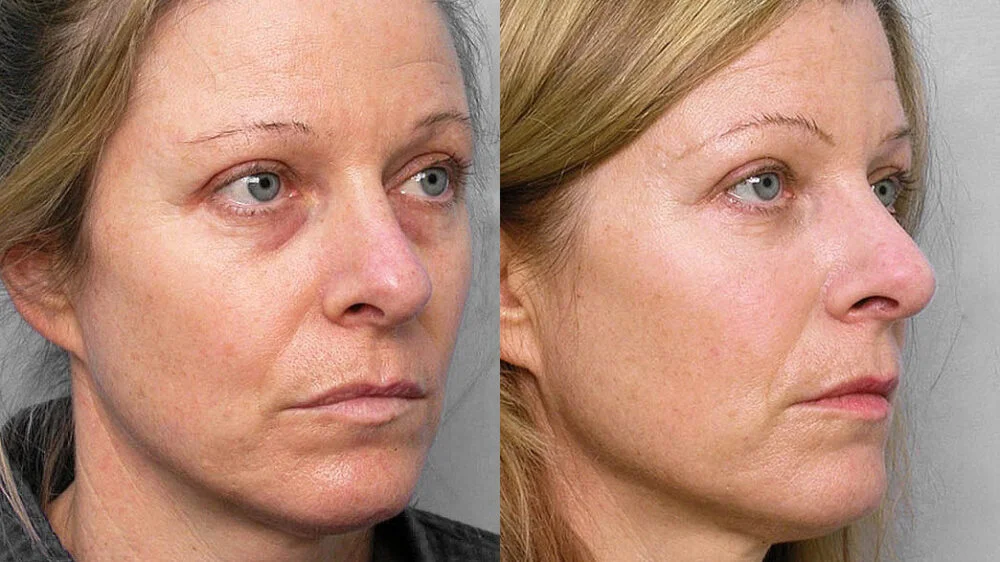 Before and after picture of a woman in right half profile, who received a fat injection under the eyes + medical skin care programme.