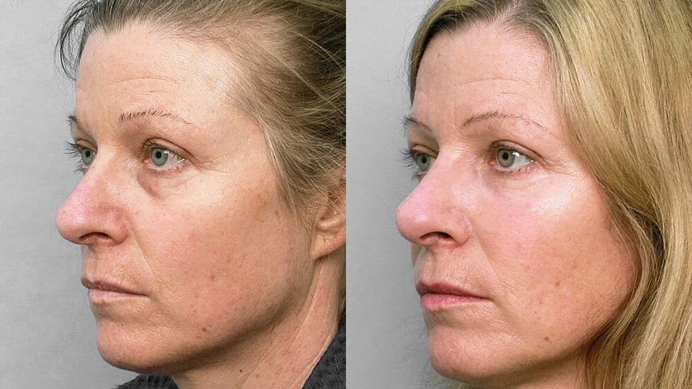 Before and after picture of a woman in left half profile, who received a fat injection under the eyes and a skin care programme.