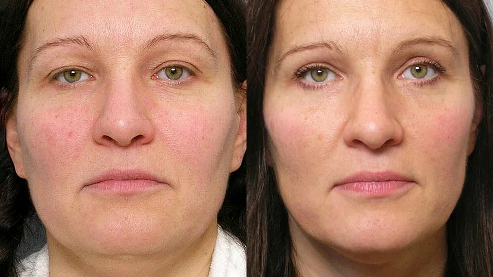 Before and after picture of a woman who has undergone fat injection under the eyes + upper eyelid surgery.