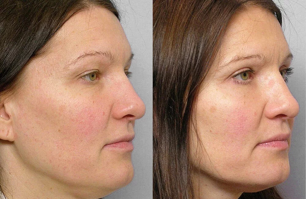 Before and after picture of a woman who has undergone fat injection under the eyes + upper eyelid surgery.